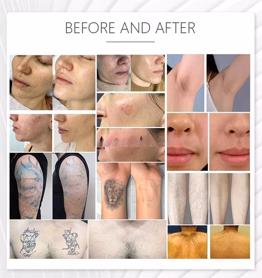 2023 M22 IPL Opt 피부 광자 회춘 미용 장비 Aopt 레이저 M22 Lumenis Resurfx Cool Haarentfernungsgerät